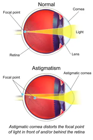 Comparison of a normal eye and the one with astigmatism